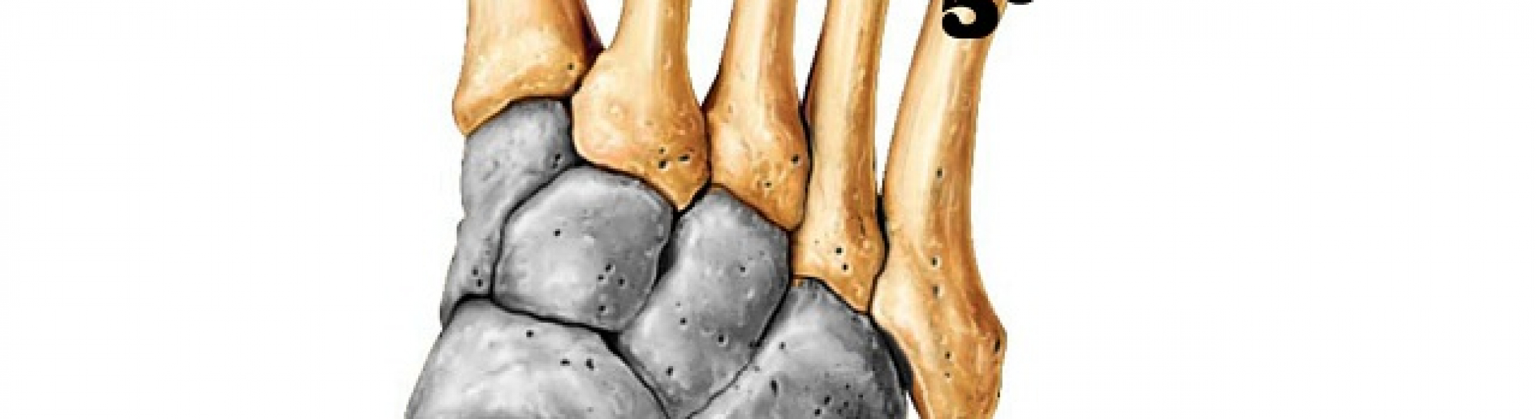 Problemas no quinto metatarso – Piés Sin Dolor
