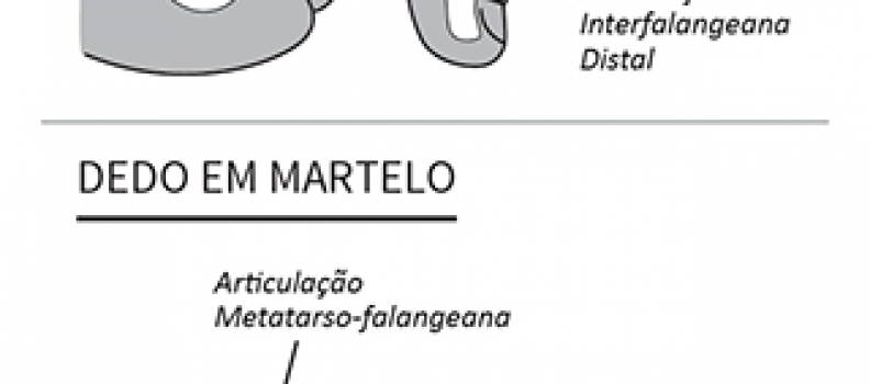 Conheça tudo sobre os dedos em garra e em martelo